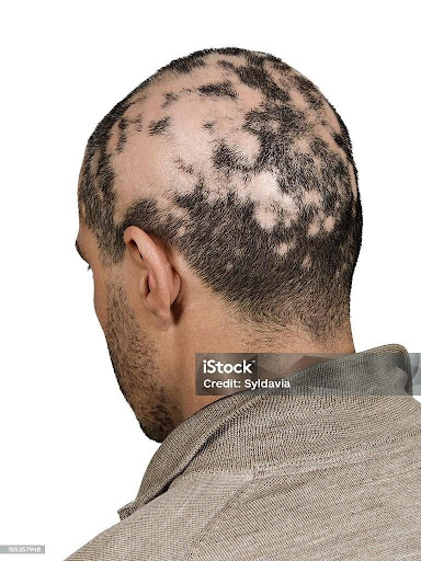 The cause of Alopecia varies from person to person. Some have bouts of hair loss throughout their lives, while others only have one episode. 