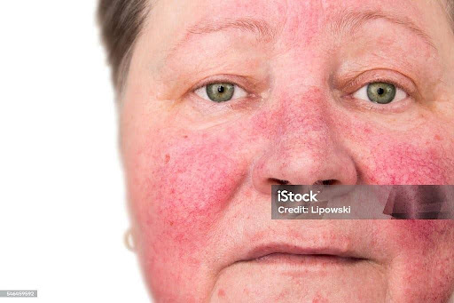 Rosacea can make your face flush more easily. Over time, you may notice that your face stays red. 