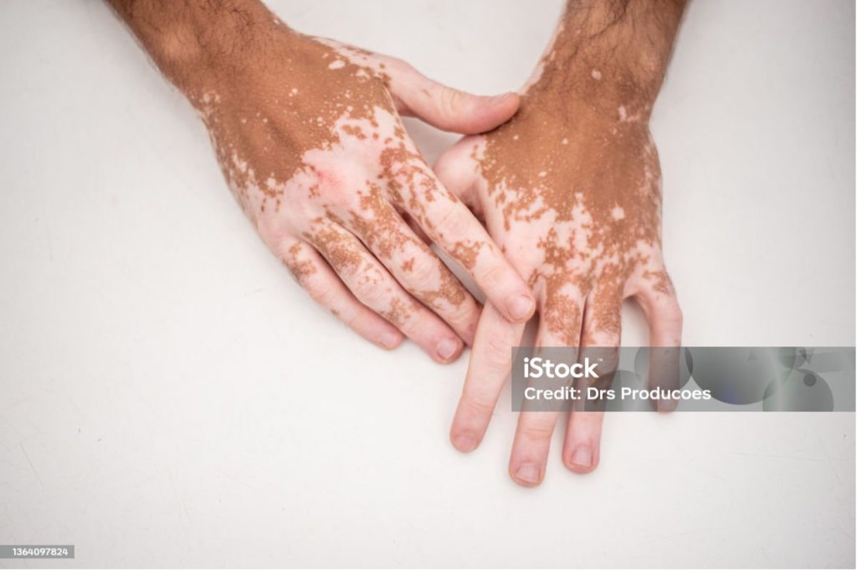 Vitiligo+is+caused+by+the+lack+of+a+pigment+called+melanin+in+the+skin.+Melanin+is+produced+by+skin+cells+called+melanocytes%2C+and+it+gives+your+skin+its+color.